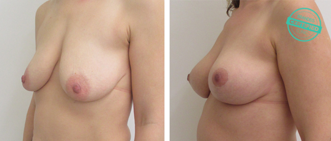 zmenseni a modelace prsou