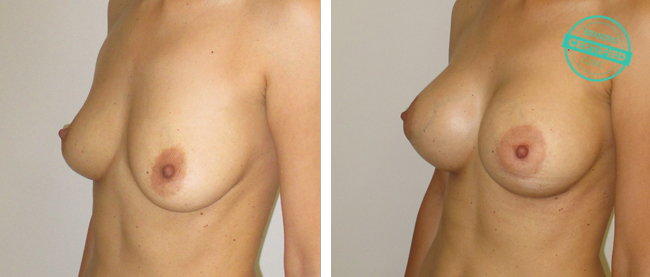 zvetseni prsou implantaty3