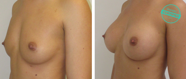 zvetseni prsou implantaty4