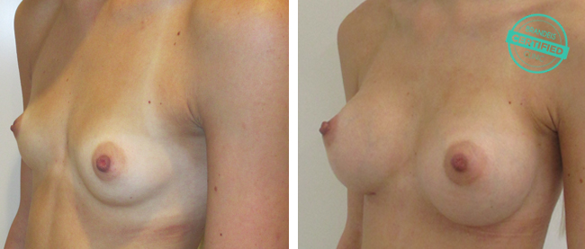 zvetseni prsou implantaty7