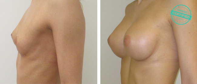 zvetseni-prsou-implantaty